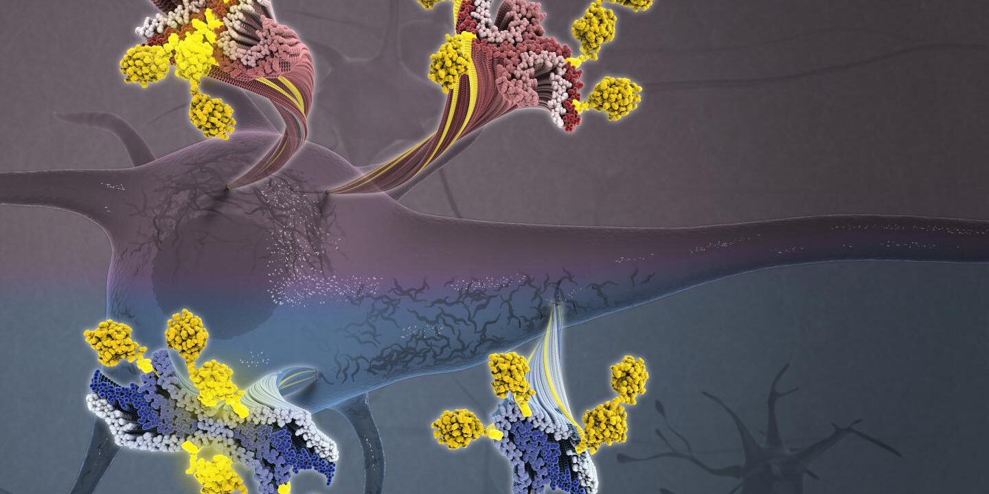 علائم و تشخیص بیماری آلزایمر