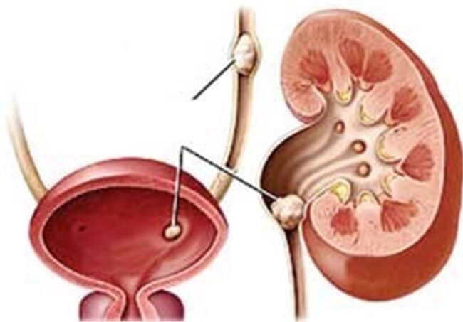 سلامت مثانه برای سالمندان