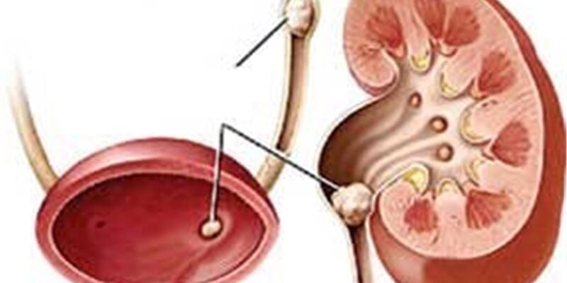 سلامت مثانه برای سالمندان