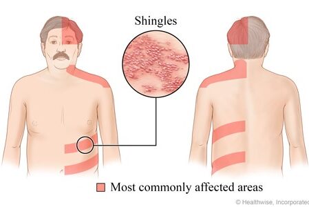  بیماری زونا در سالمندان