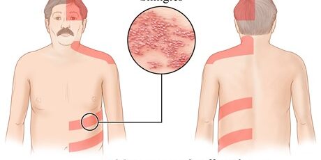  بیماری زونا در سالمندان