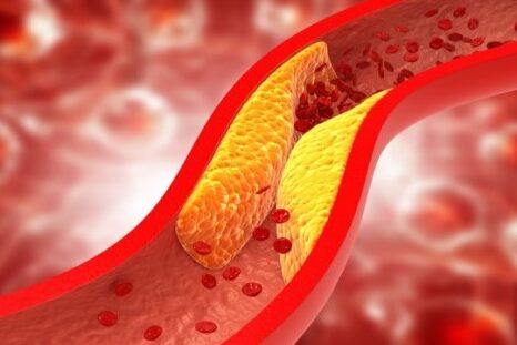 چربی خون در سالمندان