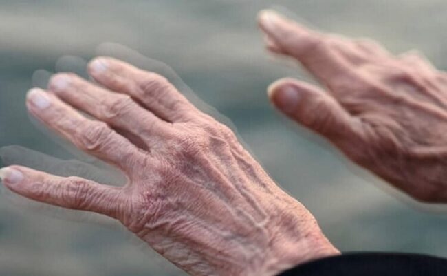 از بیماری پارکینسون چه می دانید؟ از بیماری پارکینسون چه می دانید؟